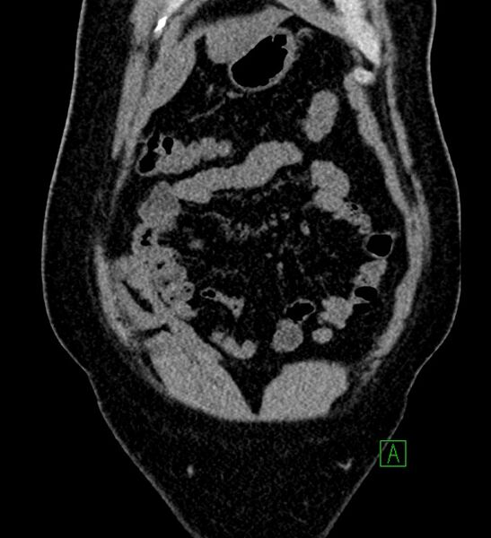 File:Chromophobe renal cell carcinoma (Radiopaedia 84286-99573 Coronal non-contrast 29).jpg