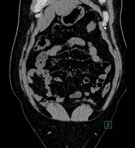 File:Chromophobe renal cell carcinoma (Radiopaedia 84286-99573 Coronal non-contrast 35).jpg