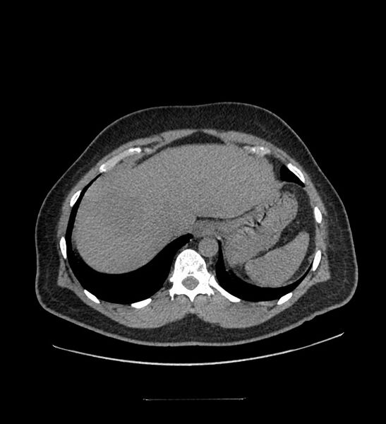 File:Chromophobe renal cell carcinoma (Radiopaedia 84337-99644 Axial non-contrast 13).jpg