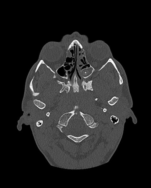 File:Chronic maxillary sinusitis caused by a foreign body (Radiopaedia 58521-65676 Axial bone window 179).jpg