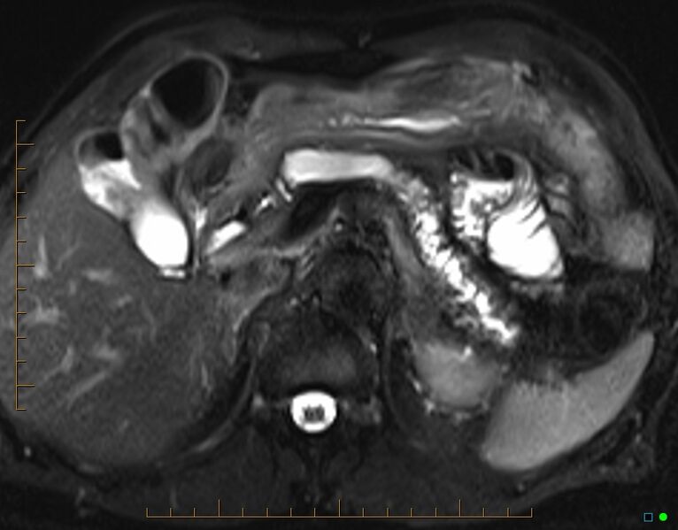 File:Chronic pancreatitis (Radiopaedia 17014-16716 Axial T2 fat sat 1).jpg