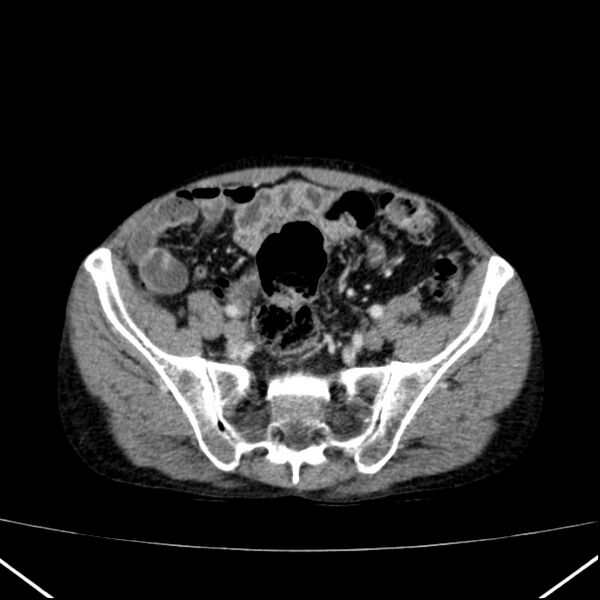 File:Chronic pancreatitis (Radiopaedia 23132-23172 B 55).jpg