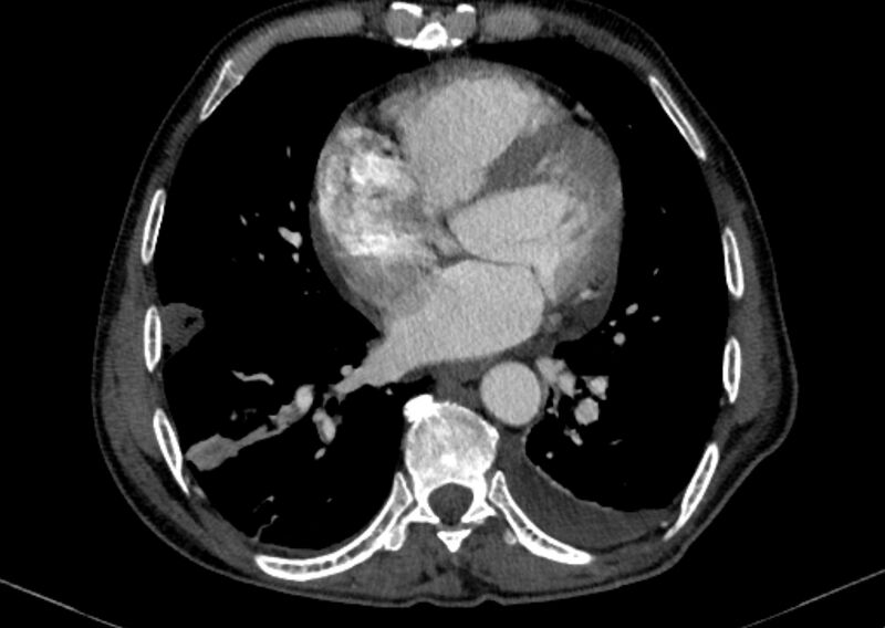File:Chronic pulmonary embolism with bubbly consolidation (Radiopaedia 91248-108850 C+ arterial phase 98).jpg