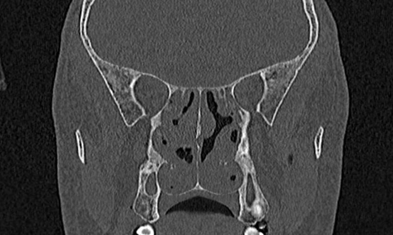 File:Chronic rhinosinusitis (Radiopaedia 65079-74075 Coronal bone window 53).jpg