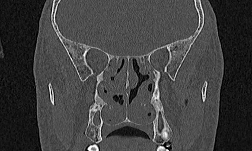 Chronic rhinosinusitis (Radiopaedia 65079-74075 Coronal bone window 53).jpg