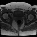 Class II Mullerian duct anomaly- unicornuate uterus with rudimentary horn and non-communicating cavity (Radiopaedia 39441-41755 Axial T1 22).jpg