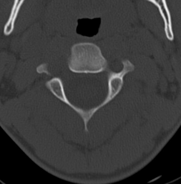 File:Cleft of the posterior arch of C1 mimicking fracture (Radiopaedia 40201-42721 Axial bone window 8).jpg