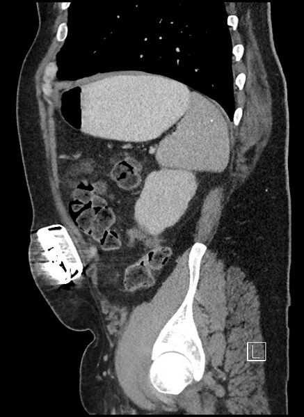 File:Closed loop obstruction - internal hernia into nephrectomy bed (Radiopaedia 59867-67320 C 14).jpg