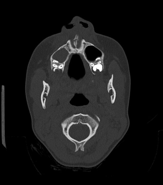 File:Nasoorbitoethmoid fracture (Radiopaedia 90044-107205 Axial bone window 50).jpg