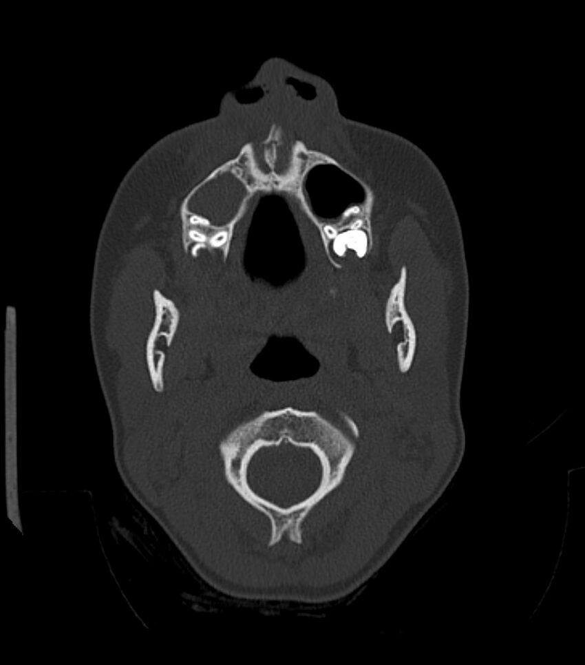 Nasoorbitoethmoid fracture (Radiopaedia 90044-107205 Axial bone window 50).jpg