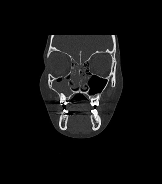 File:Nasoorbitoethmoid fracture (Radiopaedia 90044-107205 Coronal bone window 44).jpg