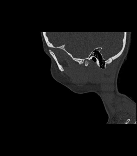 File:Nasoorbitoethmoid fracture (Radiopaedia 90044-107205 Sagittal bone window 27).jpg