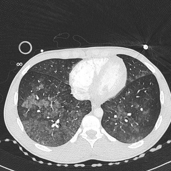 File:Near drowning (pulmonary edema) (Radiopaedia 24685-24958 lung window 59).jpg