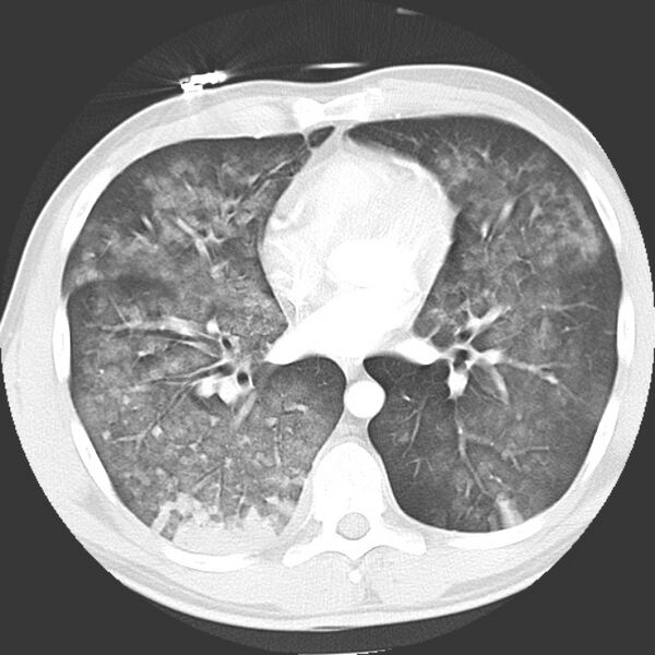 File:Near drowning pulmonary edema (Radiopaedia 16868-16591 Axial lung window 29).jpg