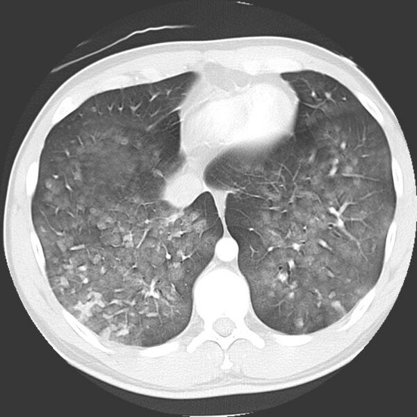File:Near drowning pulmonary edema (Radiopaedia 16868-16591 Axial lung window 40).jpg
