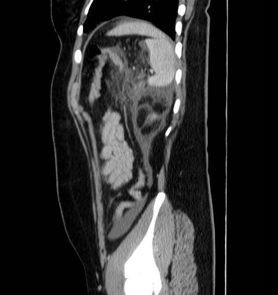 File:Necrotizing pancreatitis (Radiopaedia 23001-23031 C 68).jpg