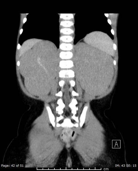 File:Nephroblastomatosis (Radiopaedia 41934-44935 B 42).jpg