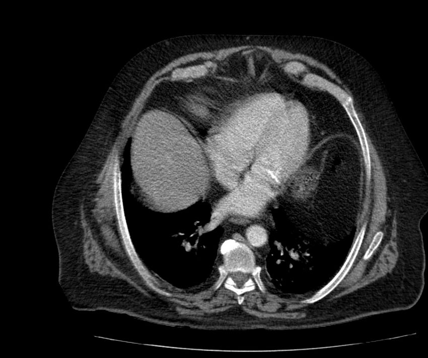 Nephroptosis with inguinal hernia containing perirenal fat (Radiopaedia 56632-63391 C 38).jpg