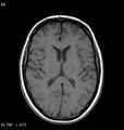 Neurosarcoidosis (Radiopaedia 10930-11351 Axial T1 11).jpg