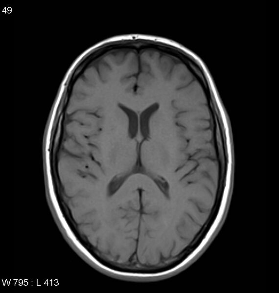 File:Neurosarcoidosis (Radiopaedia 10930-11351 Axial T1 11).jpg