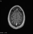 Neurosarcoidosis (Radiopaedia 10930-17204 Axial T1 C+ 18).jpg