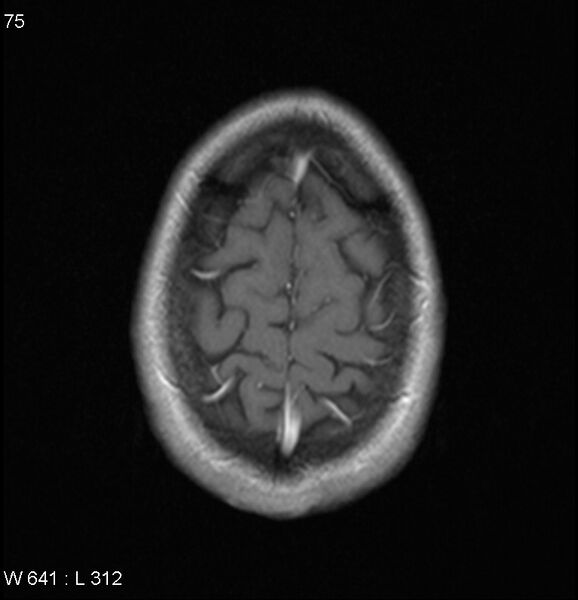 File:Neurosarcoidosis (Radiopaedia 10930-17204 Axial T1 C+ 18).jpg