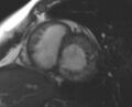 Non-compaction of the left ventricle (Radiopaedia 69436-79314 Short axis cine 150).jpg