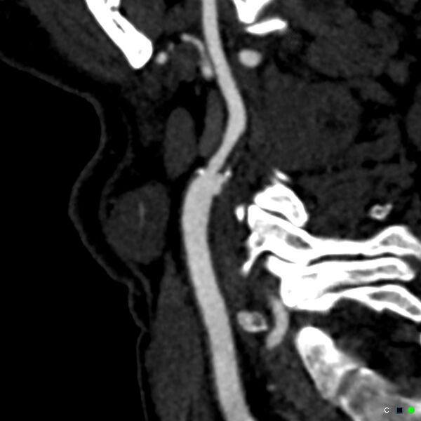 File:Non-occlusive intraluminal internal carotid artery thrombus (Radiopaedia 37751-39658 C 48).jpg