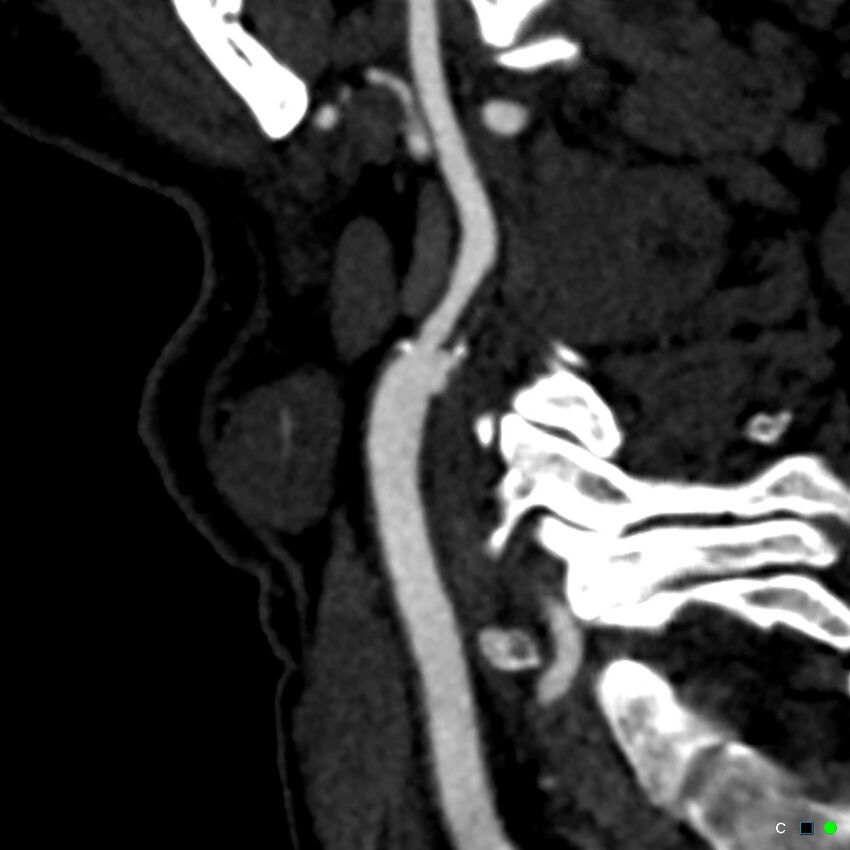 Non-occlusive intraluminal internal carotid artery thrombus (Radiopaedia 37751-39658 C 48).jpg