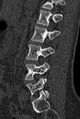 Normal CT lumbar spine (Radiopaedia 53981-60118 Sagittal bone window 66).jpg