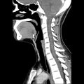 Normal CT of the neck (Radiopaedia 14575-14500 Sagittal C+ 27).jpg