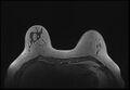 Normal breast MRI - dense breasts (Radiopaedia 80454-93850 Axial T1 54).jpg