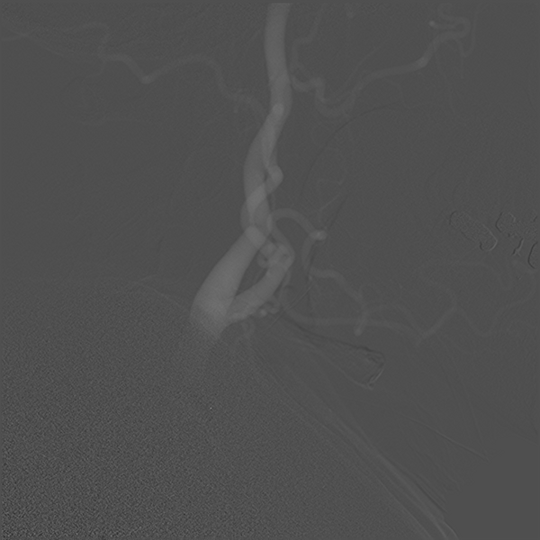 File:Normal cerebral angiogram (four vessel DSA) (Radiopaedia 41708-44649 C 8).png