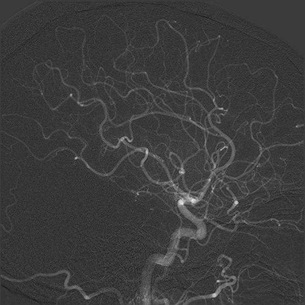 File:Normal cerebral angiogram (four vessel DSA) (Radiopaedia 41708-44649 F 10).png