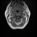 Normal cervical and thoracic spine MRI (Radiopaedia 35630-37156 Axial T1 25).png