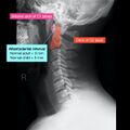 Normal cervical spine radiographs (Radiopaedia 32505-96698 Lateral 3).jpeg