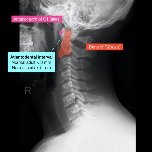 File:Normal cervical spine radiographs (Radiopaedia 32505-96698 Lateral 3).jpeg