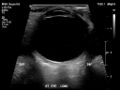 Normal eye ultrasound (Radiopaedia 70415-80514 A 8).jpg