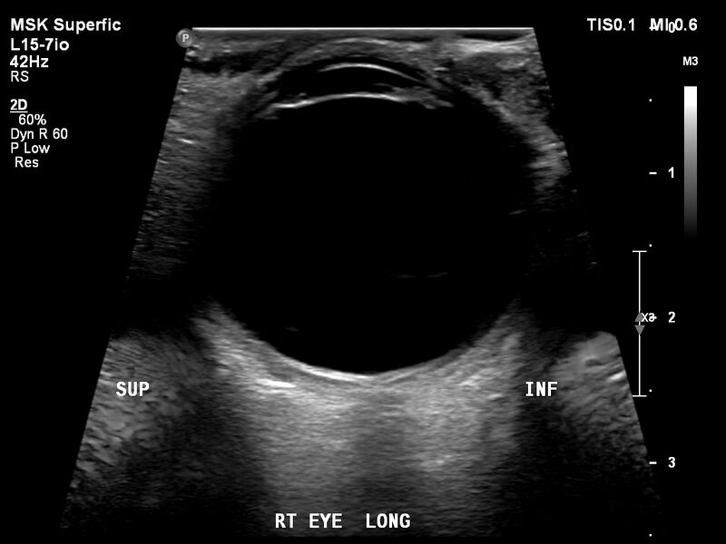 File:Normal eye ultrasound (Radiopaedia 70415-80514 A 8).jpg