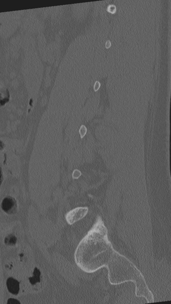 File:Normal lumbar spine CT (Radiopaedia 46533-50986 Sagittal bone window 32).png