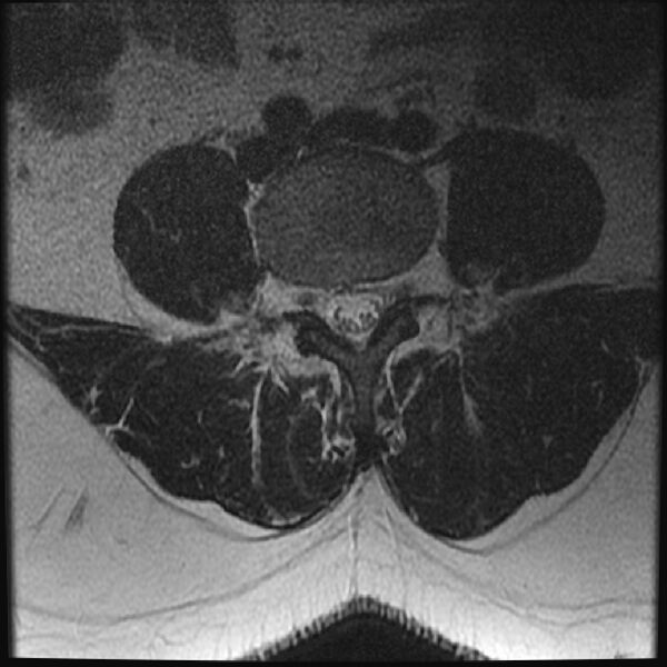 File:Normal lumbar spine MRI (Radiopaedia 43051-46311 Axial T2 16).jpg