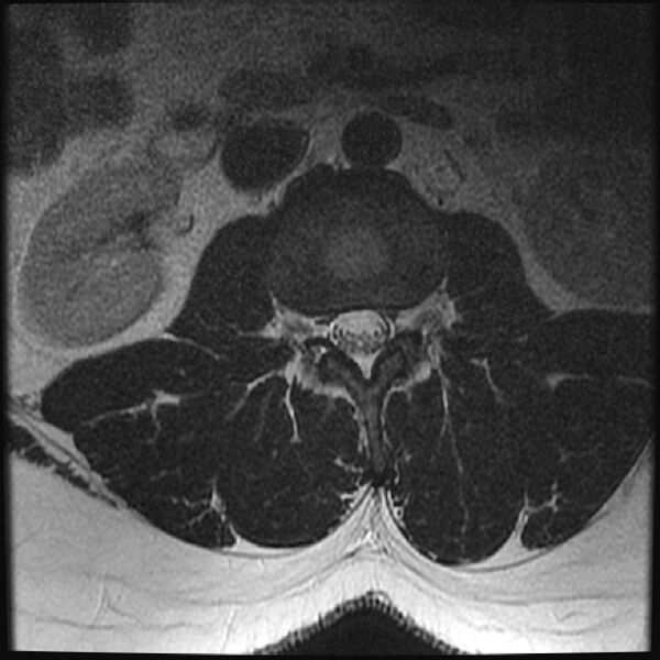 File:Normal lumbar spine MRI (Radiopaedia 43051-46311 Axial T2 7).jpg