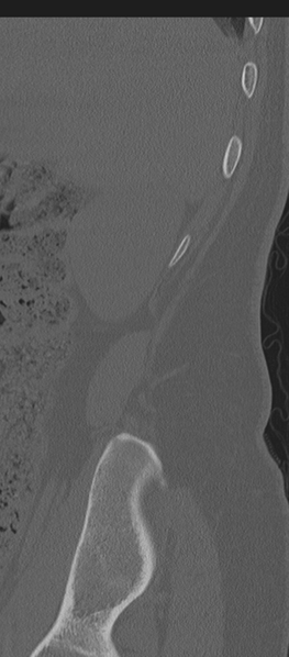 File:Normal lumbosacral CT (Radiopaedia 37923-39867 Sagittal bone window 97).png
