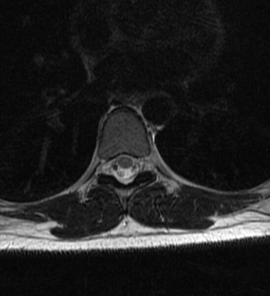 File:Normal thoracic spine MRI (Radiopaedia 41033-43781 Axial T2 1).jpg