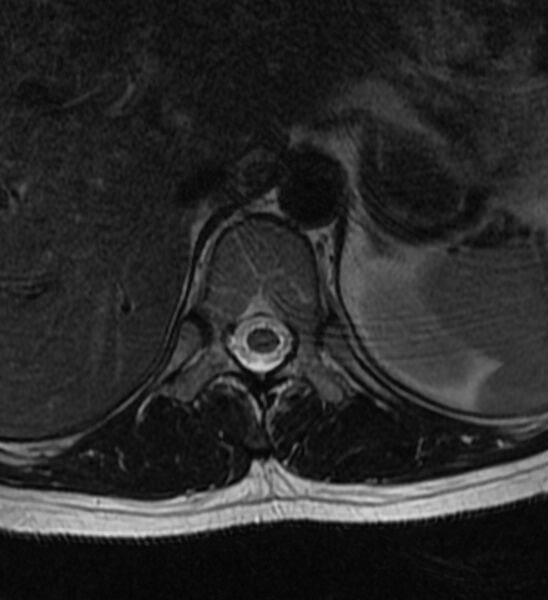File:Normal thoracic spine MRI (Radiopaedia 41033-43781 Axial T2 22).jpg