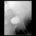 Normal voiding cystourethrogram (Radiopaedia 41432-44308 Lateral 1).png