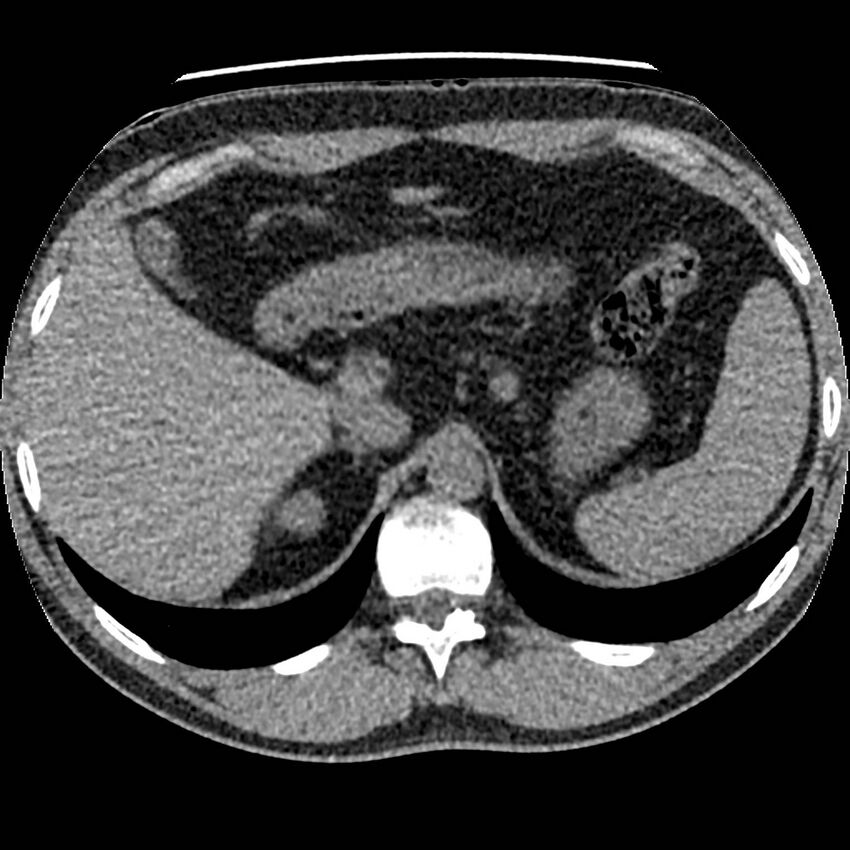 Obstructing ureteric calculus and ureteric anatomy (Radiopaedia 62730-71042 Axial non-contrast 4).jpg