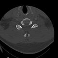 Occipital condyle fracture (Radiopaedia 31755-32691 Axial bone window 54).jpg