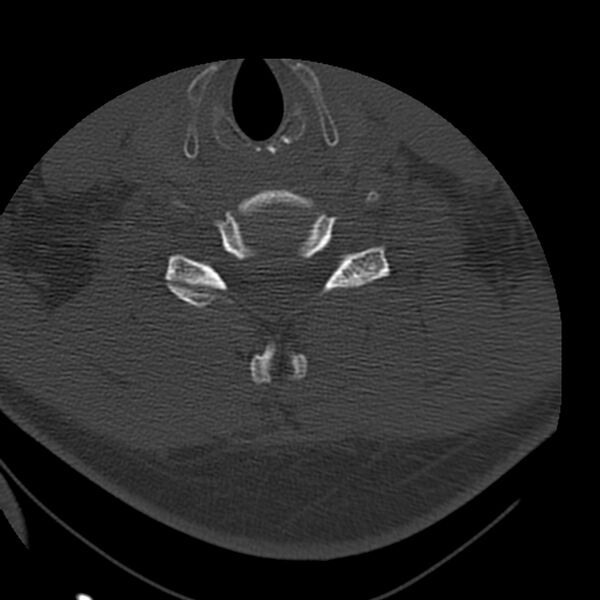 File:Occipital condyle fracture (Radiopaedia 31755-32691 Axial bone window 54).jpg