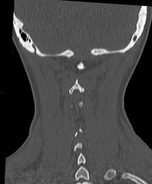 File:Occipital condyle fracture (Radiopaedia 61165-69056 Coronal bone window 2).jpg